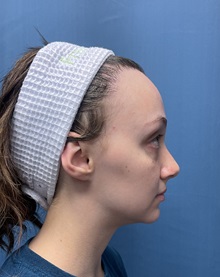 Brow Lift Before Photo by Lisa Brostrom, MD; San Antonio, TX - Case 49850