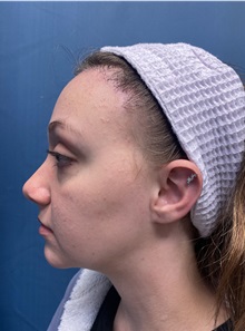 Brow Lift After Photo by Lisa Brostrom, MD; San Antonio, TX - Case 49850