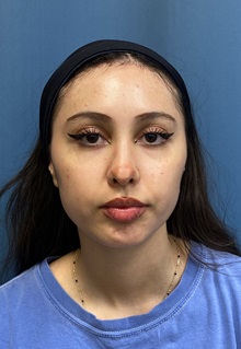 Brow Lift After Photo by Lisa Brostrom, MD; San Antonio, TX - Case 49847