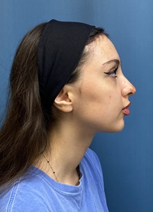 Brow Lift After Photo by Lisa Brostrom, MD; San Antonio, TX - Case 49847