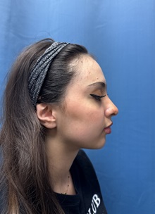 Brow Lift Before Photo by Lisa Brostrom, MD; San Antonio, TX - Case 49847