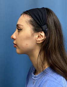 Brow Lift After Photo by Lisa Brostrom, MD; San Antonio, TX - Case 49847