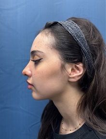 Brow Lift Before Photo by Lisa Brostrom, MD; San Antonio, TX - Case 49847