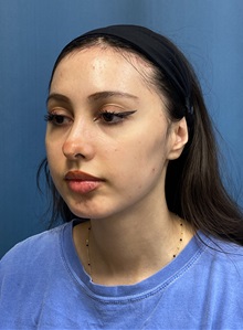 Brow Lift After Photo by Lisa Brostrom, MD; San Antonio, TX - Case 49847