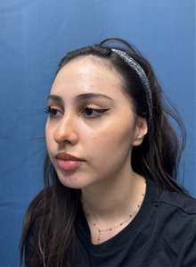 Brow Lift Before Photo by Lisa Brostrom, MD; San Antonio, TX - Case 49847