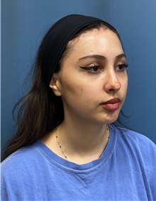 Brow Lift After Photo by Lisa Brostrom, MD; San Antonio, TX - Case 49847