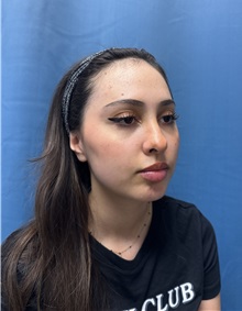 Brow Lift Before Photo by Lisa Brostrom, MD; San Antonio, TX - Case 49847