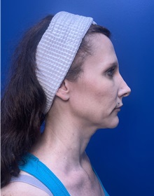 Brow Lift Before Photo by Lisa Brostrom, MD; San Antonio, TX - Case 49852