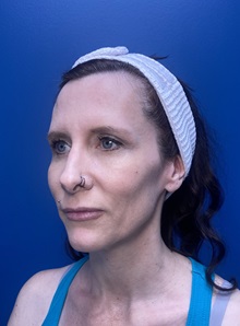 Brow Lift Before Photo by Lisa Brostrom, MD; San Antonio, TX - Case 49852