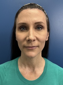 Brow Lift After Photo by Lisa Brostrom, MD; San Antonio, TX - Case 49852 Brow Lift After Photo by Lisa Brostrom, MD; San Antonio, TX - Case 49852