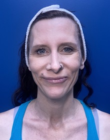 Brow Lift Before Photo by Lisa Brostrom, MD; San Antonio, TX - Case 49852 Brow Lift Before Photo by Lisa Brostrom, MD; San Antonio, TX - Case 49852
