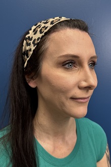 Brow Lift After Photo by Lisa Brostrom, MD; San Antonio, TX - Case 49852