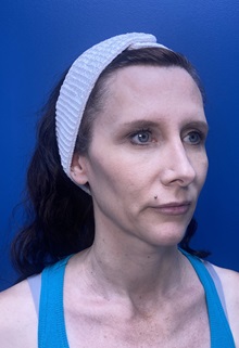 Brow Lift Before Photo by Lisa Brostrom, MD; San Antonio, TX - Case 49852
