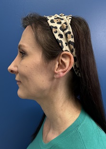 Brow Lift After Photo by Lisa Brostrom, MD; San Antonio, TX - Case 49852