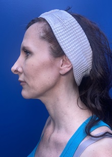 Brow Lift Before Photo by Lisa Brostrom, MD; San Antonio, TX - Case 49852