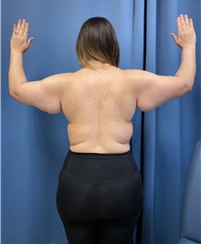 Arm Lift Before Photo by Lisa Brostrom, MD; San Antonio, TX - Case 49864