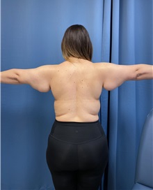 Arm Lift Before Photo by Lisa Brostrom, MD; San Antonio, TX - Case 49864