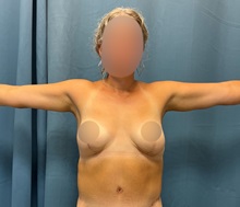 Arm Lift After Photo by Lisa Brostrom, MD; San Antonio, TX - Case 49867