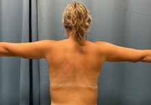 Arm Lift After Photo by Lisa Brostrom, MD; San Antonio, TX - Case 49867