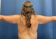 Arm Lift Before Photo by Lisa Brostrom, MD; San Antonio, TX - Case 49867