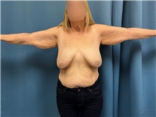 Arm Lift Before Photo by Lisa Brostrom, MD; San Antonio, TX - Case 49865