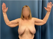 Arm Lift Before Photo by Lisa Brostrom, MD; San Antonio, TX - Case 49865