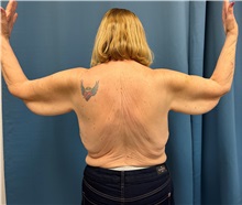 Arm Lift Before Photo by Lisa Brostrom, MD; San Antonio, TX - Case 49865