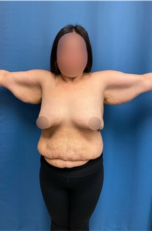 Arm Lift Before Photo by Lisa Brostrom, MD; San Antonio, TX - Case 49866