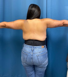 Arm Lift After Photo by Lisa Brostrom, MD; San Antonio, TX - Case 49866