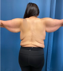 Arm Lift Before Photo by Lisa Brostrom, MD; San Antonio, TX - Case 49866