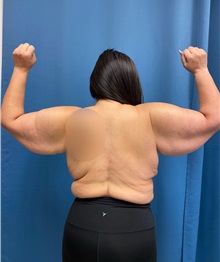 Arm Lift Before Photo by Lisa Brostrom, MD; San Antonio, TX - Case 49866