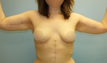 Arm Lift After Photo by Lisa Brostrom, MD; San Antonio, TX - Case 49868 Arm Lift After Photo by Lisa Brostrom, MD; San Antonio, TX - Case 49868