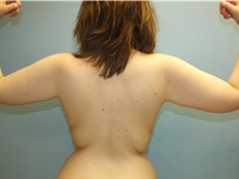 Arm Lift After Photo by Lisa Brostrom, MD; San Antonio, TX - Case 49868