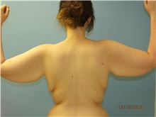 Arm Lift Before Photo by Lisa Brostrom, MD; San Antonio, TX - Case 49868