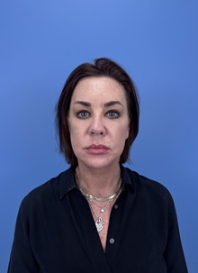 Facelift After Photo by Lisa Brostrom, MD; San Antonio, TX - Case 49911