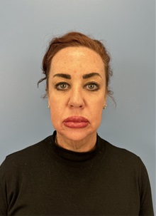 Facelift Before Photo by Lisa Brostrom, MD; San Antonio, TX - Case 49911