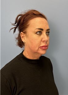 Facelift Before Photo by Lisa Brostrom, MD; San Antonio, TX - Case 49911