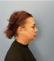 Facelift Before Photo by Lisa Brostrom, MD; San Antonio, TX - Case 49911