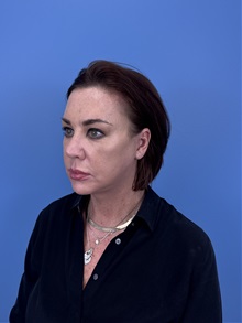 Facelift After Photo by Lisa Brostrom, MD; San Antonio, TX - Case 49911