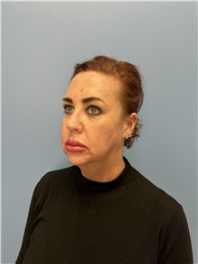 Facelift Before Photo by Lisa Brostrom, MD; San Antonio, TX - Case 49911