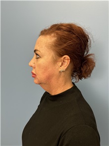 Facelift Before Photo by Lisa Brostrom, MD; San Antonio, TX - Case 49911