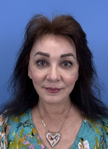 Brow Lift After Photo by Lisa Brostrom, MD; San Antonio, TX - Case 49915 Brow Lift After Photo by Lisa Brostrom, MD; San Antonio, TX - Case 49915