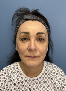 Brow Lift Before Photo by Lisa Brostrom, MD; San Antonio, TX - Case 49915 Brow Lift Before Photo by Lisa Brostrom, MD; San Antonio, TX - Case 49915