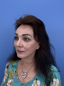 Brow Lift After Photo by Lisa Brostrom, MD; San Antonio, TX - Case 49915