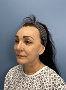 Brow Lift Before Photo by Lisa Brostrom, MD; San Antonio, TX - Case 49915
