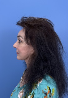 Brow Lift After Photo by Lisa Brostrom, MD; San Antonio, TX - Case 49915