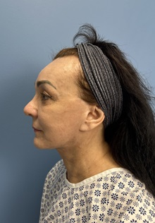 Brow Lift Before Photo by Lisa Brostrom, MD; San Antonio, TX - Case 49915