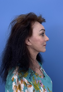 Brow Lift After Photo by Lisa Brostrom, MD; San Antonio, TX - Case 49915