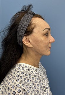 Brow Lift Before Photo by Lisa Brostrom, MD; San Antonio, TX - Case 49915