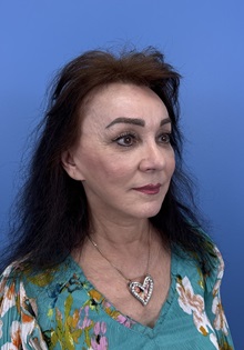 Brow Lift After Photo by Lisa Brostrom, MD; San Antonio, TX - Case 49915